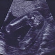 20 Weeks - It's a Girl!
